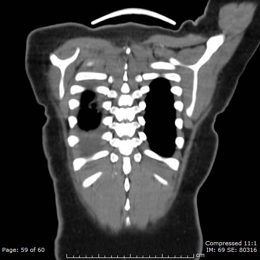 File:Anterior mediastinal B cell Lymphoma (Radiopaedia 50677-56114 B 30).jpg