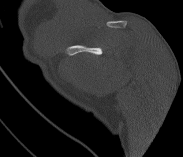 Anterior shoulder dislocation with Hill-Sachs and bony Bankart lesions (Radiopaedia 40424-42974 Coronal bone window 37).png