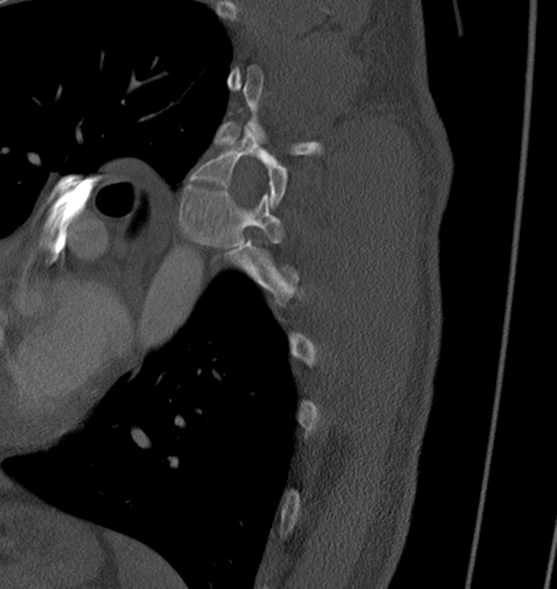 Anterior shoulder dislocation with Hill-Sachs and bony Bankart lesions (Radiopaedia 40424-42974 Sagittal bone window 74).png