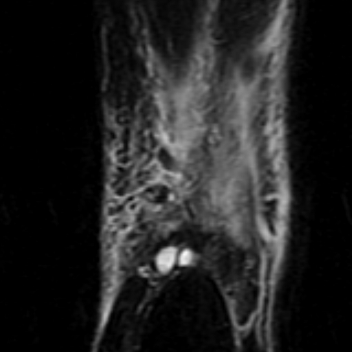 File:Anterior talofibular ligament rupture (Radiopaedia 15831-15484 Coronal STIR 21).jpg