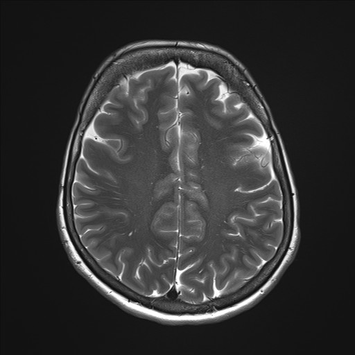 File:Anterior temporal encephalocele (Radiopaedia 82624-96808 Axial T2 27).jpg