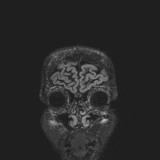 Anterior temporal encephalocele (Radiopaedia 82624-96808 Coronal FLAIR 3).jpg