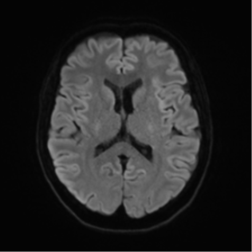 Anterior temporal lobe perivascular space (Radiopaedia 40946-43650 Axial DWI 42).png