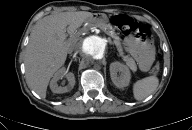 File:Anterior vertebral scalloping (abdominal aortic aneurysm) (Radiopaedia 66744-76067 F 14).jpg