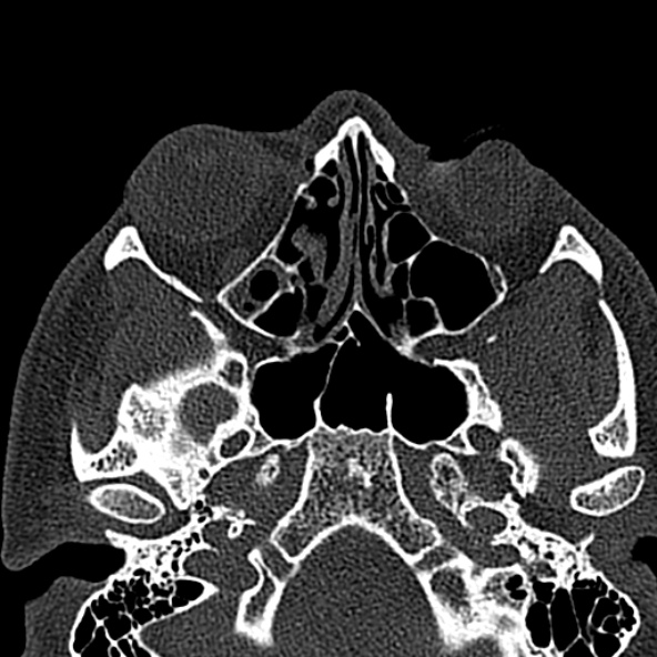 Antrochoanal polyp (Radiopaedia 30002-30554 Axial bone window 33).jpg