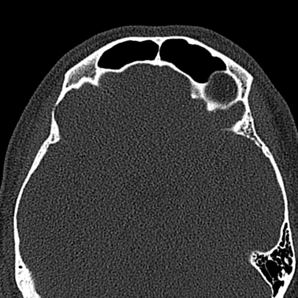 Antrochoanal polyp (Radiopaedia 30002-30554 Axial bone window 49).jpg