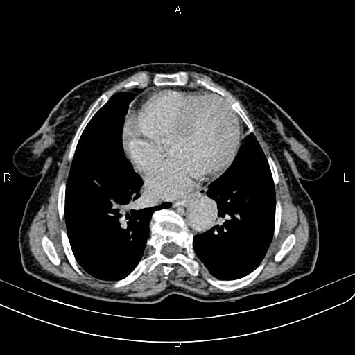 File:Aortic aneurysm and Lemmel syndrome (Radiopaedia 86499-102554 Axial C+ delayed 1).jpg