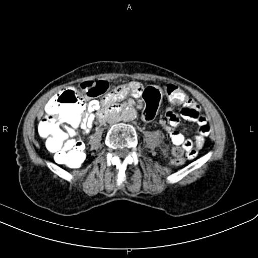 Aortic aneurysm and Lemmel syndrome (Radiopaedia 86499-102554 Axial C+ delayed 44).jpg