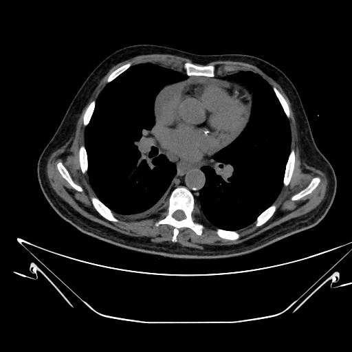 Aortic arch aneurysm (Radiopaedia 84109-99365 Axial non-contrast 150).jpg