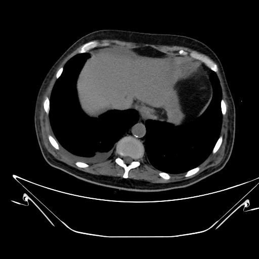 File:Aortic arch aneurysm (Radiopaedia 84109-99365 Axial non-contrast 238).jpg