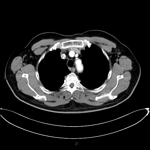 Aortic arch origin of left vertebral artery (Radiopaedia 46327-50737 Axial post contrast 28).jpg