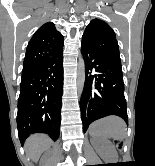Aortic coarctation with aneurysm (Radiopaedia 74818-85828 C 86).jpg