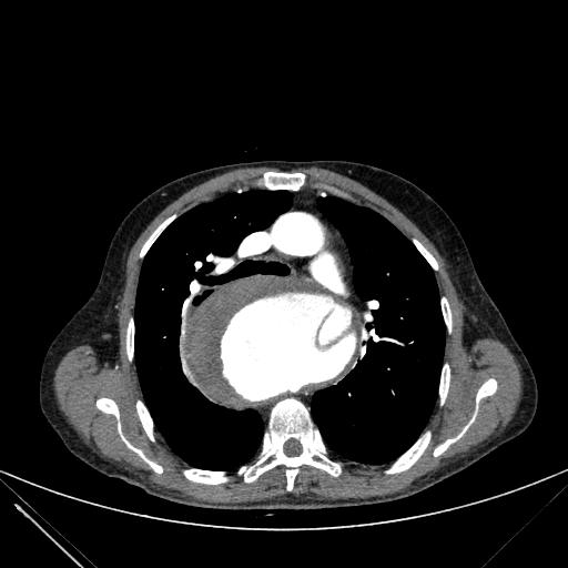 Aortic dissection (Radiopaedia 27466-27665 C+ arterial phase 87).jpg
