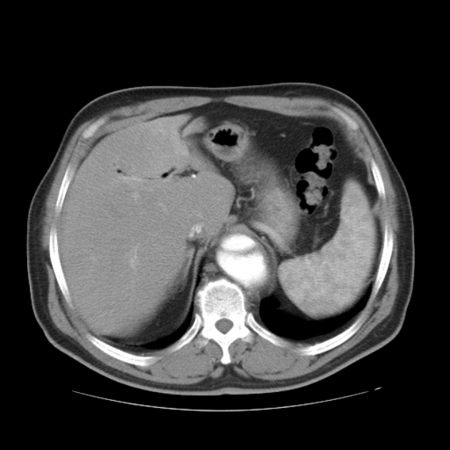 Aortic dissection (Radiopaedia 44411-48061 C 24).jpg