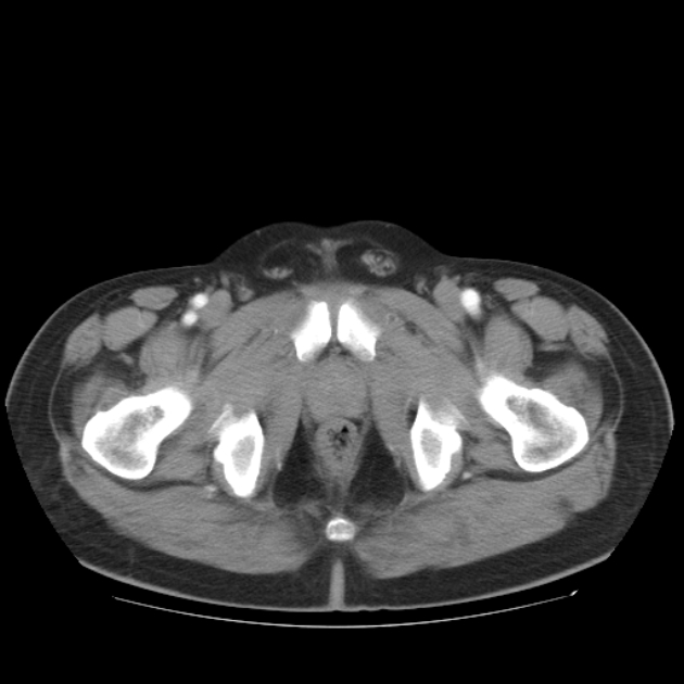 Aortic dissection (Radiopaedia 44411-48061 C 59).jpg