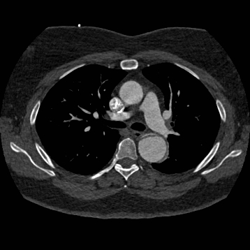 Aortic dissection (Radiopaedia 57969-64959 A 129).jpg
