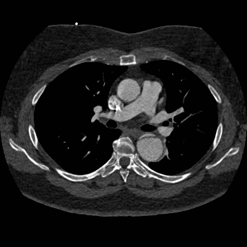File:Aortic dissection (Radiopaedia 57969-64959 A 140).jpg