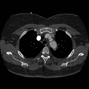 Aortic dissection (Radiopaedia 57969-64959 A 78).jpg