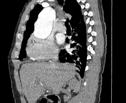 Aortic dissection - Stanford A -DeBakey I (Radiopaedia 28339-28587 C 4).jpg