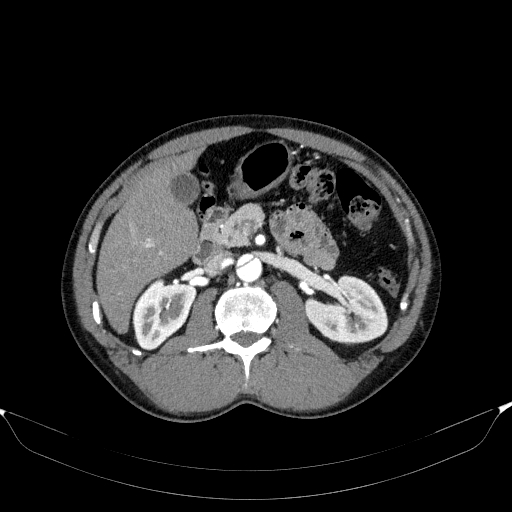 Aortic dissection - Stanford type A (Radiopaedia 83418-98500 A 72).jpg