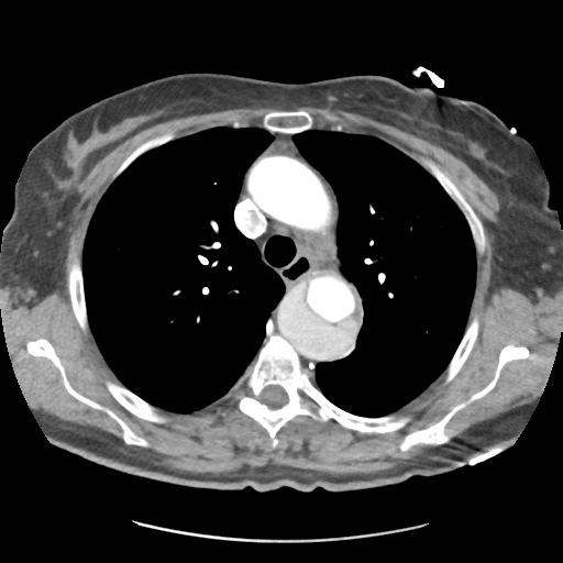 Aortic dissection - Stanford type B (Radiopaedia 50171-55512 A 16).png