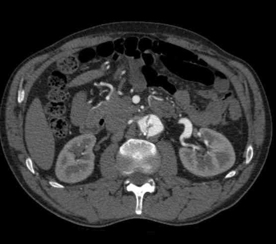 Aortic dissection - Stanford type B (Radiopaedia 73648-84437 A 148).jpg