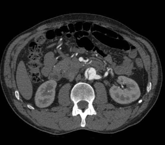 Aortic dissection - Stanford type B (Radiopaedia 73648-84437 A 151).jpg