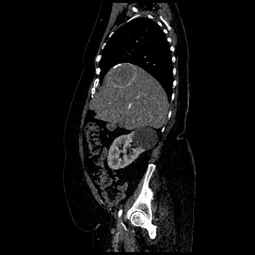 Aortic dissection - Stanford type B (Radiopaedia 88281-104910 C 20).jpg