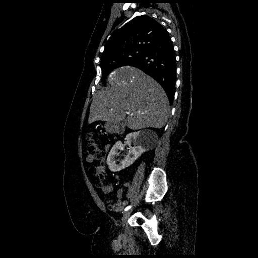 File:Aortic dissection - Stanford type B (Radiopaedia 88281-104910 C 23).jpg