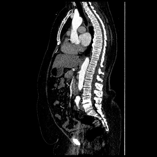 File:Aortic dissection - Stanford type B (Radiopaedia 88281-104910 C 37).jpg