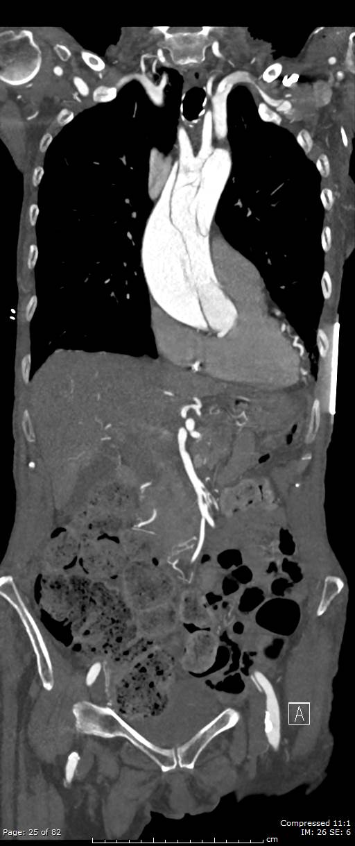 Aortic dissection with extension into aortic arch branches (Radiopaedia 64402-73204 A 25).jpg