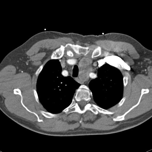 Aortic intramural hematoma (Radiopaedia 31139-31838 B 17).jpg