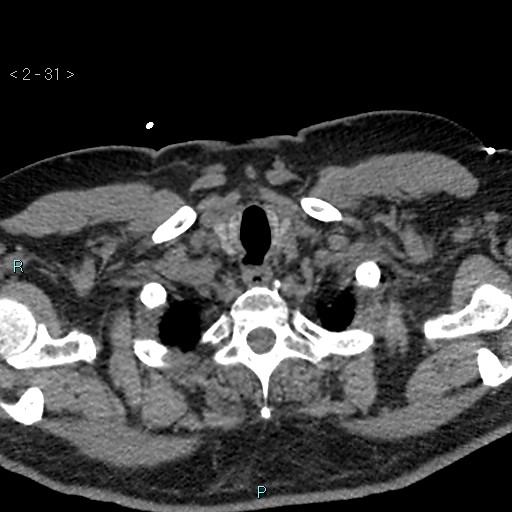 Aortic intramural hematoma (Radiopaedia 48463-53380 Axial non-contrast 13).jpg