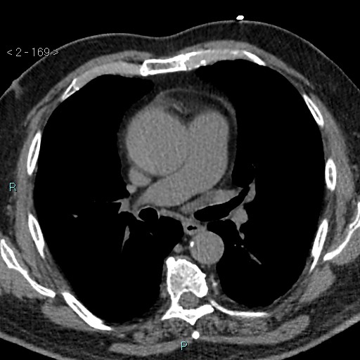Aortic intramural hematoma (Radiopaedia 48463-53380 Axial non-contrast 75).jpg