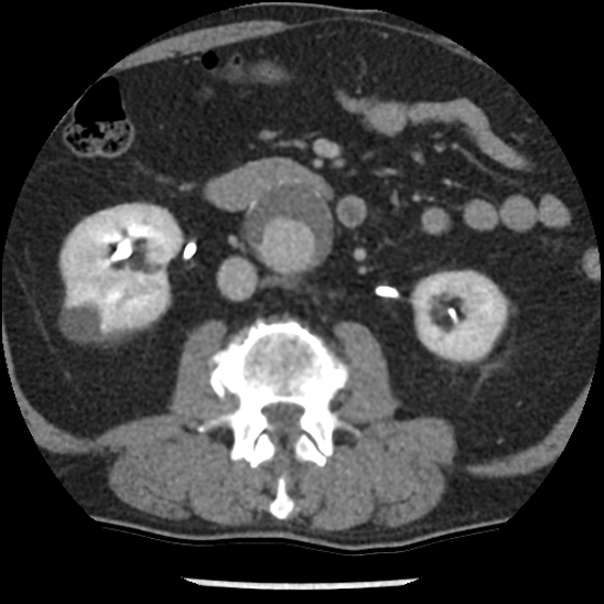 File:Aortic intramural hematoma (type B) (Radiopaedia 79323-92387 Axial C+ delayed 73).jpg