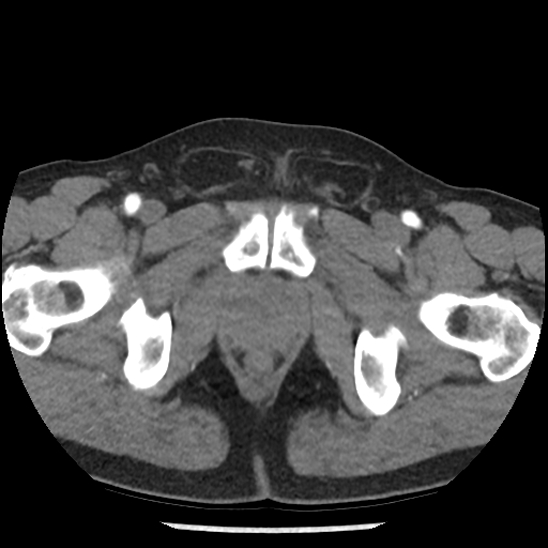 File:Aortic intramural hematoma (type B) (Radiopaedia 79323-92387 B 117).jpg