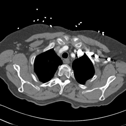 Aortic intramural hematoma from penetrating atherosclerotic ulcer (Radiopaedia 31137-31836 A 11).jpg