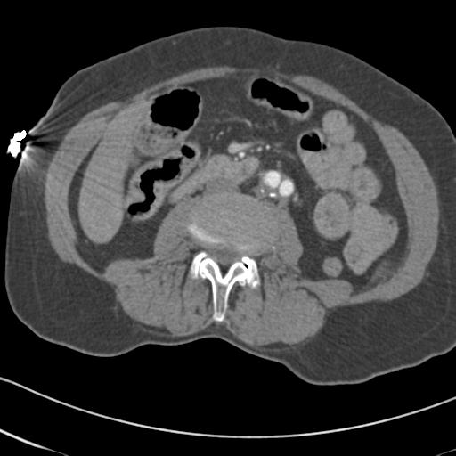 Aortic intramural hematoma from penetrating atherosclerotic ulcer (Radiopaedia 31137-31836 A 114).jpg