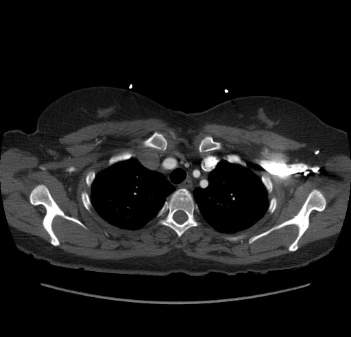 Aortic nipple (Radiopaedia 63008-71449 B 13).jpg