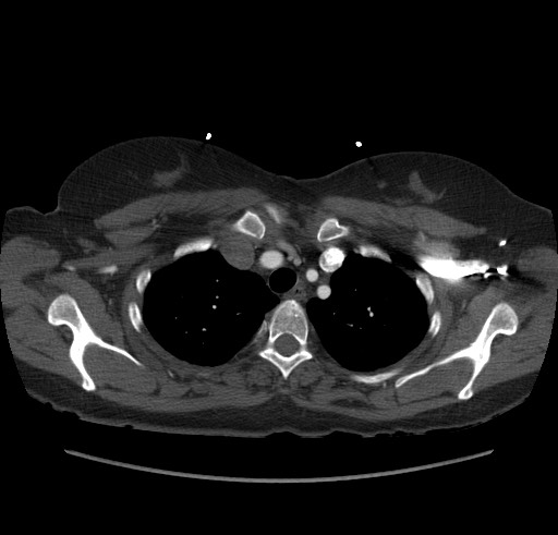 Aortic nipple (Radiopaedia 63008-71449 B 14).jpg