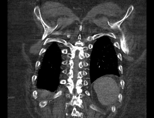 Aortoesophageal fistula with endovascular repair (Radiopaedia 73781-84592 Coronal C+ CTPA 118).jpg