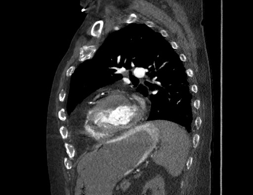 File:Aortoesophageal fistula with endovascular repair (Radiopaedia 73781-84592 Sagittal C+ CTPA 135).jpg