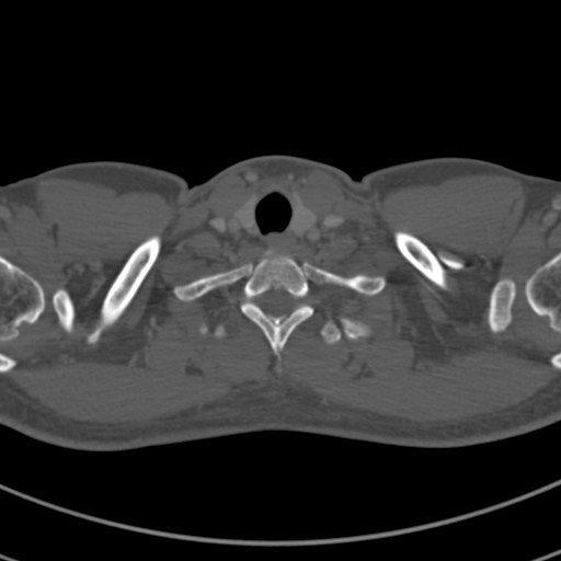 Apical lung mass mimic - neurogenic tumor (Radiopaedia 59918-67521 Axial bone window 2).jpg
