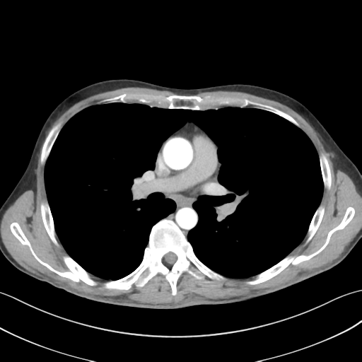 File:Apical pleural calcification (Radiopaedia 46141-50499 Axial C+ delayed 31).png