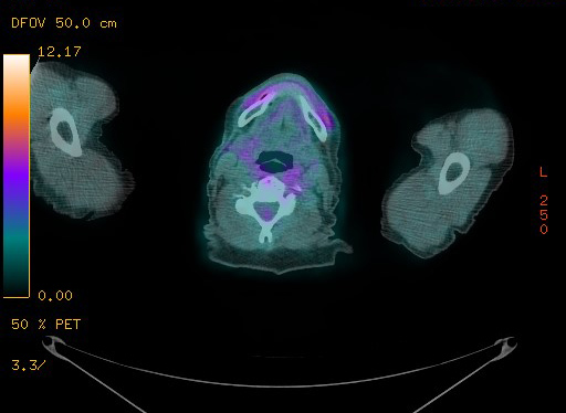 File:Appendiceal adenocarcinoma complicated by retroperitoneal abscess (Radiopaedia 58007-65041 Axial PET-CT 13).jpg