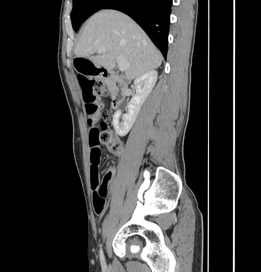 Appendiceal mucinous adenocarcinoma (Radiopaedia 66605-75922 C 21).jpg