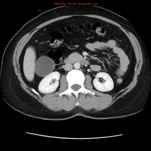 Appendiceal mucinous cystadenoma (Radiopaedia 8263-9111 Axial liver window 37).jpg