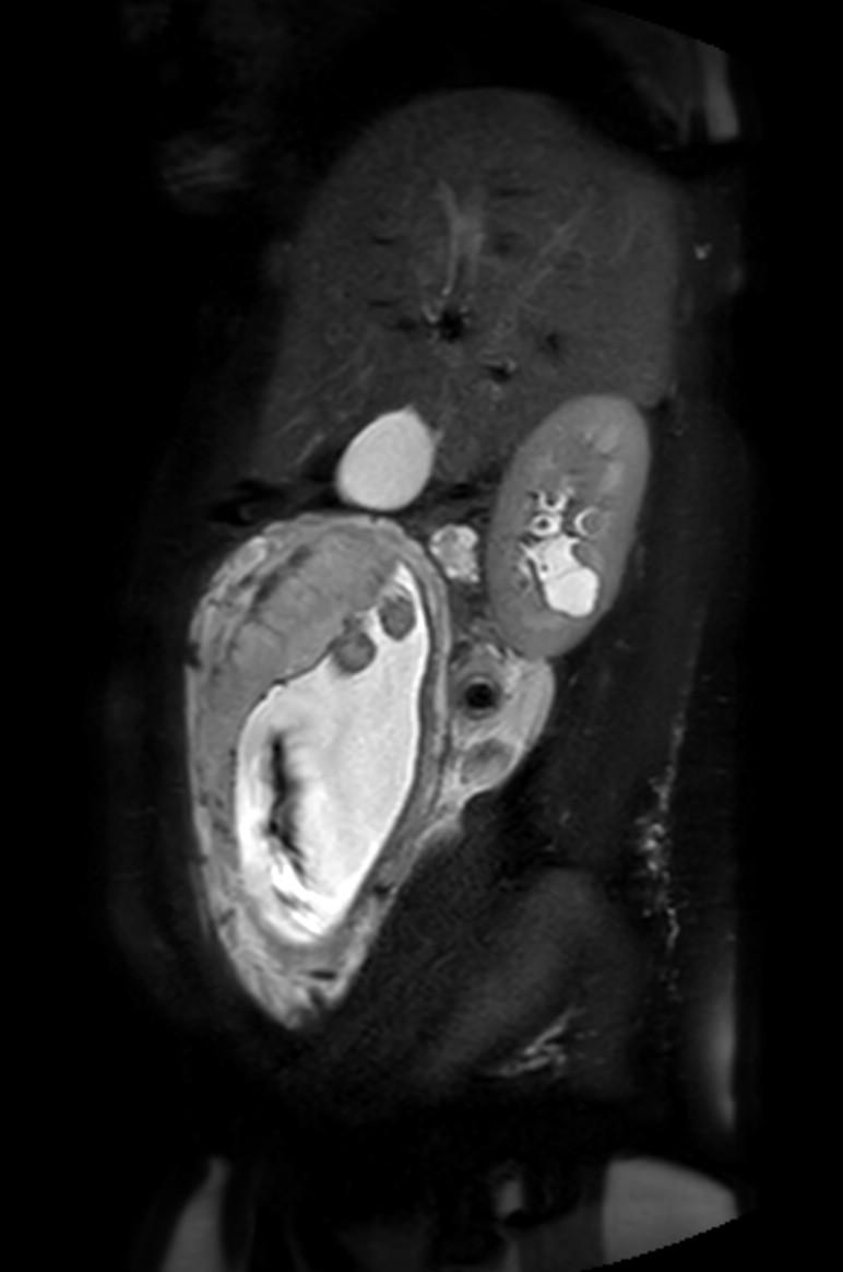 Appendicitis in gravida (MRI) (Radiopaedia 89433-106395 Sagittal T2 SPAIR 45).jpg