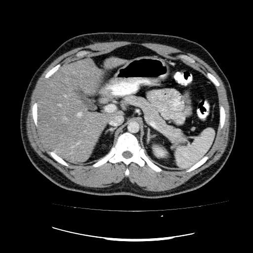 File:Appendicitis with diverticulosis (Radiopaedia 47693-52383 Axial C+ 36).jpg