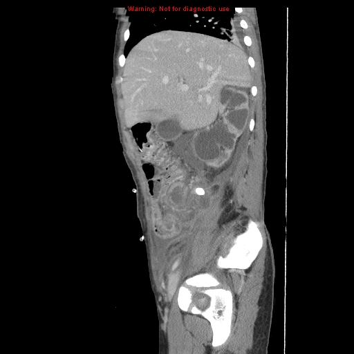 File:Appendicitis with phlegmon (Radiopaedia 9358-10046 F 14).jpg
